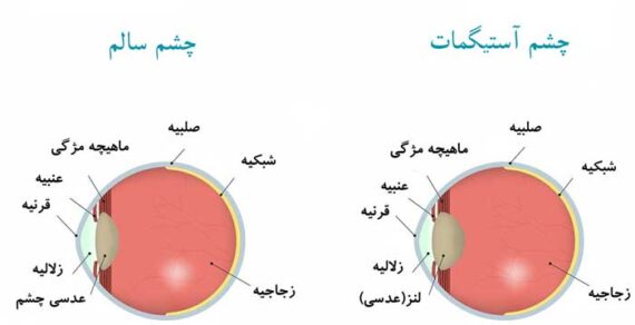 آستیگمات چشم چیست و عمل آن چگونه انجام میگیرد؟ (فیلم) - سالم زیبا