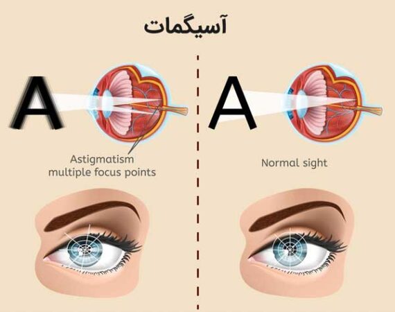آیا آستیگمات با لیزیک درمان میشود؟ (و پاسخ به 4 سوال رایج) - سالم زیبا