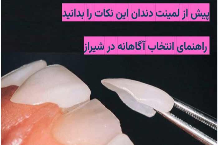 نکات لمینت دندان