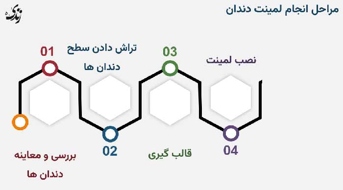 مراحل انجام لمینت دندان به زبان ساده