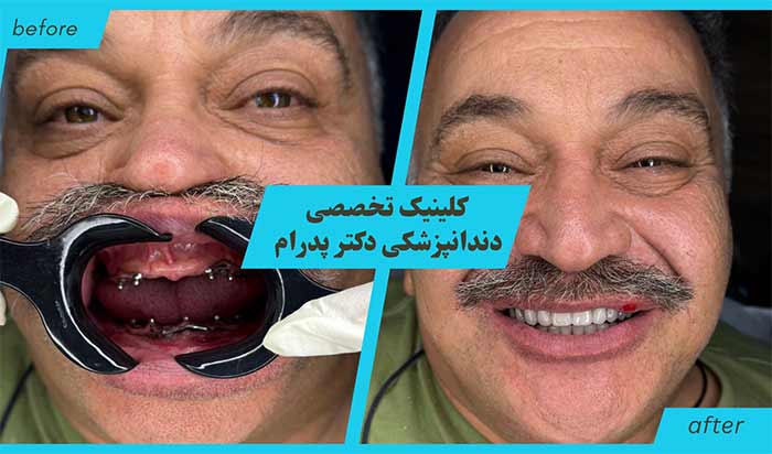 زیبایی دندان