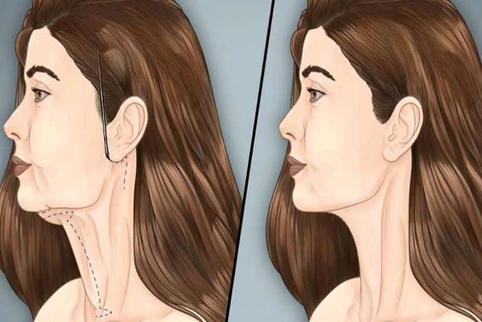 مقایسه جامع ۵ روش جوانسازی گردن: از تکنیک‌های کلینیکی تا مراقبت‌های خانگی