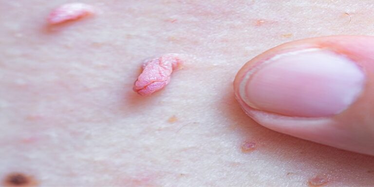 10 روش ساده برای پیشگیری از زگیل تناسلی که همه باید بدانند