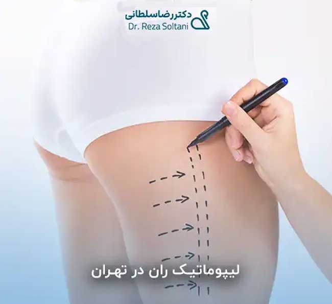 لیپوماتیک ران