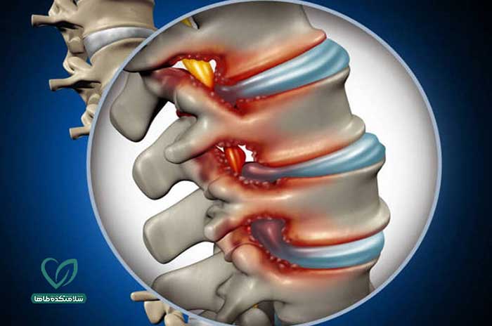 راه‌های آرام کردن درد دیسک کمر