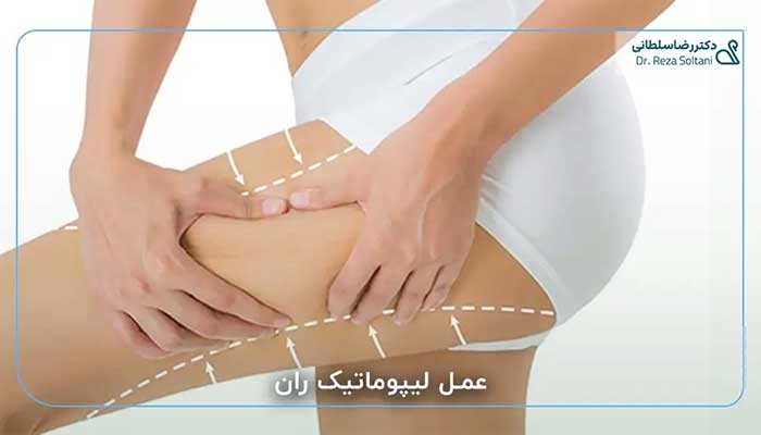 عمل لیپوماتیک ران